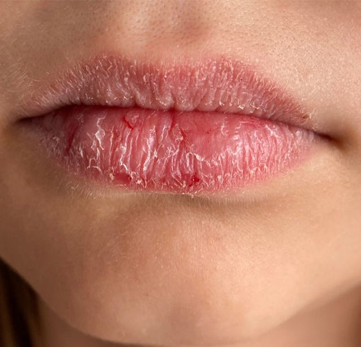 Soğuk hava dudaklarımıza neler yapıyor!